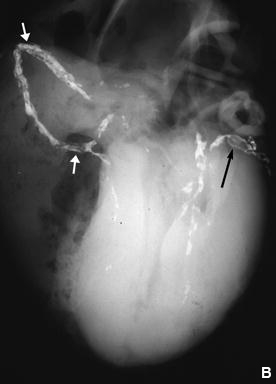 Figure 9. Post-mortem X-rays of 3 hearts before injection of barium gelatin mass (A, B, D) and the dissected coronaries of one heart not injected (C).