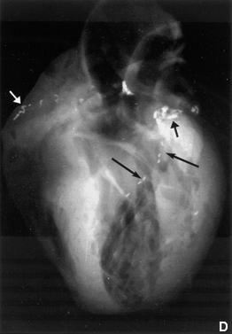 Figure 9. Post-mortem X-rays of 3 hearts before injection of barium gelatin mass (A, B, D) and the dissected coronaries of one heart not injected (C).