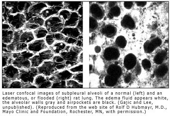 Image lung.jpg