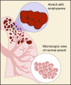 Lung alveoli. In AAT deficiency, the walls of the lung tissue (alveoli) are broken down.