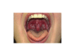 Figure 1. . A 15-year-old girl with fever and exudative streptococcal pharyngitis (from (Block, 2014)).