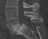 Grade II Spondylolisthesis, CT