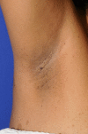 Axillary freckling in Neurofibromatosis type 1 Contributed by Drs