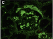 Systemic AL Amyloidosis, Pathology, Immunofluorescence, Glomerular amyloid deposits positively stained with anti-lambda conjugate Contributed by Desport et al