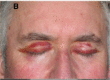 Systemic AL Amyloidosis, Pathology, Bilateral Periorbital purpura, Eyelids Contributed by Desport et al