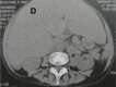 Systemic AL Amyloidosis, Pathology, Voluminous Hepatomegaly due to primary hepatic amyloidosis, Liver, CT scan Contributed by Desport et al