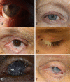 Eye Disorders and Trachoma-Associated Symptoms, Trichiasis