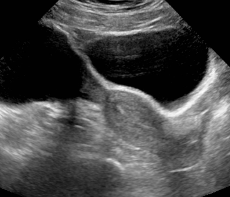 Transabdominal Long Image of Normal Uterus, Ultrasound