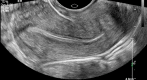 Transvaginal longitudinal view of the uterus Contributed by Dr