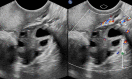 Sonographic image of the right ovary with and without doppler evaluation