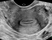 Transverse/coronal view of the uterus