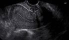 Transvaginal Long Image of a Normal Uterus