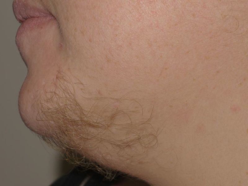 Image hirsutism