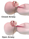 Infant Airway