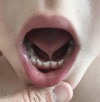 Ankyloglossia