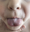 Heart-shaped deformity of the tongue due to ankyloglossia