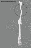 Diaphyseal Femur Fracture