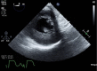 Papillary Muscle Rupture on Transesophageal Echocardiography