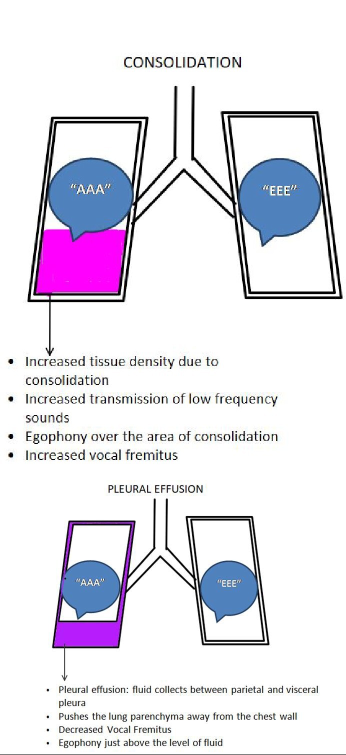 Image consolidation__and__plural__effusion