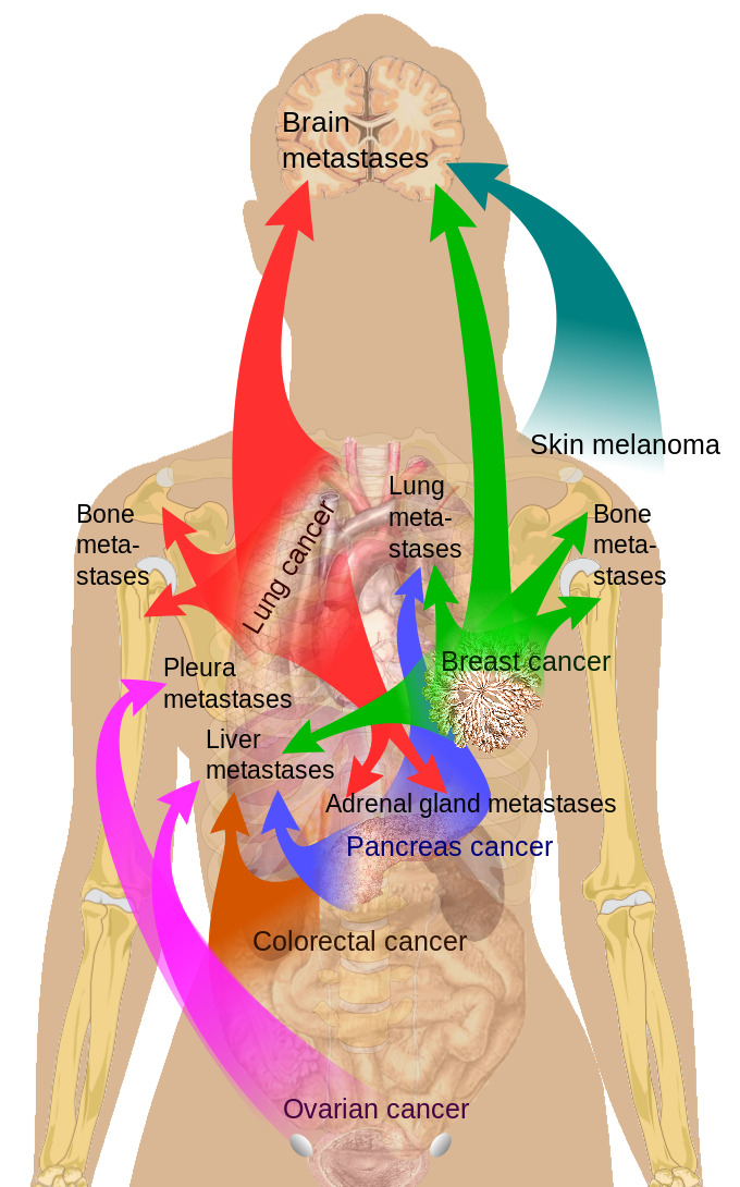 Common Sites of Breast Cancer Metastasis