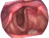 Unilateral Vocal Cord Paralysis After a Left Parathyroidectomy