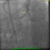 Coronary angiogram in a patient with radiation-induced coronary artery disease showing severe obstructive left main disease with bifurcation lesion affecting the Ostia of the left anterior descending artery and the left circumflex artery