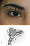 Fig 1: A: upper eyelid platform; B: Brow to Lid margin distance; C: Upper eyelid crease; D: Upper eyelid fold; E: Brow fatpad; F: Eyelid margin and eyelash curve Fig 2: A: Frontalis muscle; B: Orbicularis muscle; C: Brow fat pad; D: Orbital septum; E: Preaponeurotic fat pads; F: Levator muscle; G: Levator aponeurosis; H: Whitnall ligament; I: Muller muscle; J: Common sheath; K: Superior rectus muscle Contributed by Professor Bhupendra C