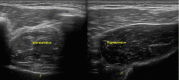 Supraspinatus Muscle Atrophy, Ultrasound