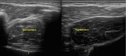 Supraspinatus Muscle Atrophy, Ultrasound