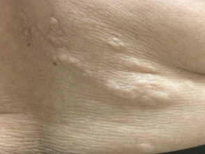 Shagreen Patch of Tuberous Sclerosis