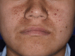 Facial Angiofibromas Observed in Tuberous Sclerosis