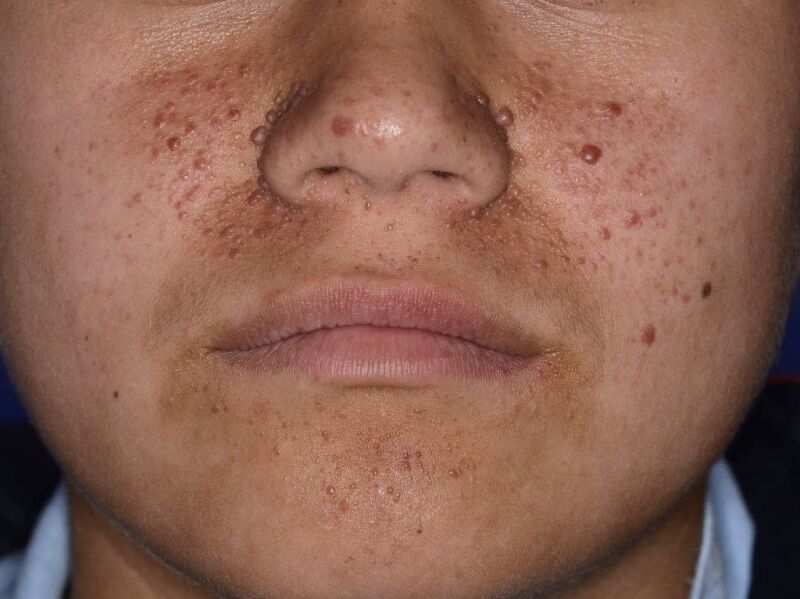 Facial Angiofibromas Observed in Tuberous Sclerosis