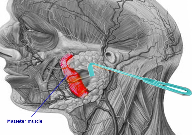 Image Masseter