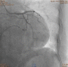 Fig. 11.3. Coronary angiogram of left coronary artery which was unobstructed.