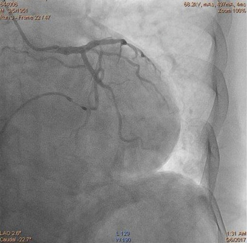 Fig. 11.3. Coronary angiogram of left coronary artery which was unobstructed.