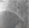 Fig. 11.5. Direct stenting, Promus Element Plus 3.