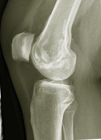 Villonodular synovitis Image courtesy O