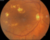 Macular Edema Associated With Diabetes