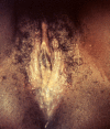 This photograph depicted a close view of a patient’s vulva, revealing evidence of an outbreak of herpes genitalis, which had manifested as a pustular-vesicular rash around the vaginal introitus due to the herpes simplex virus type-2 (HSV-2) virus