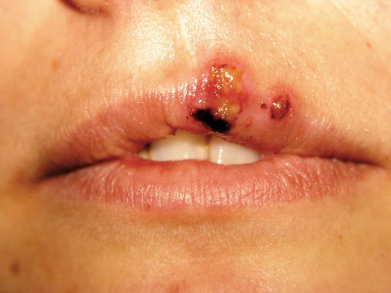 Image herpes__simplex