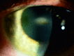 Example of corneal opacity in keratoendotheliitis fugax hereditaria