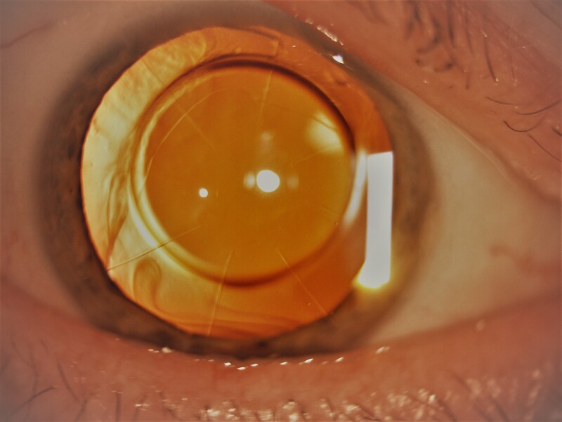 Standard 8-incision radial keratotomy with sparing of the pupillary zone