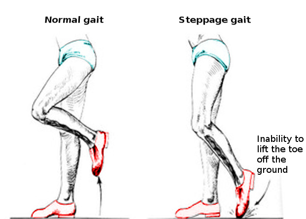 Steppage Gait Contributed by O