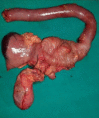 Pancreaticoduodenectomy (Whipple Procedure)