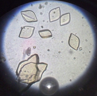 Uric Acid Crystals, Rosette-Shaped