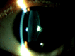 Pediatric Cataract, Posterior Lenticonus