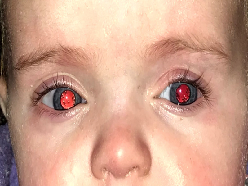 Congenital Cataracts and Abnormal Galactose Metabolism