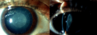 Slit-Lamp Examination of Pediatric Zonular Cataract