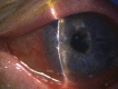 Peripheral Ulcerative Keratitis in Rheumatoid Arthritis