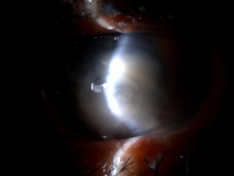 Slit lamp image of the patient depicting corneal melt, full thickness corneal infiltrate in a patient with pseudomonas endogenous endophthalmitis Contributed by Dr